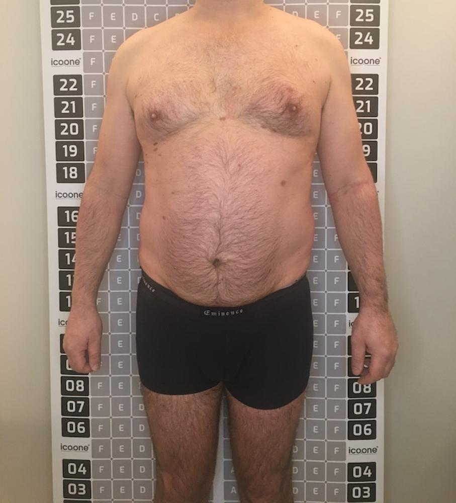 Avant cure amincissante Lille