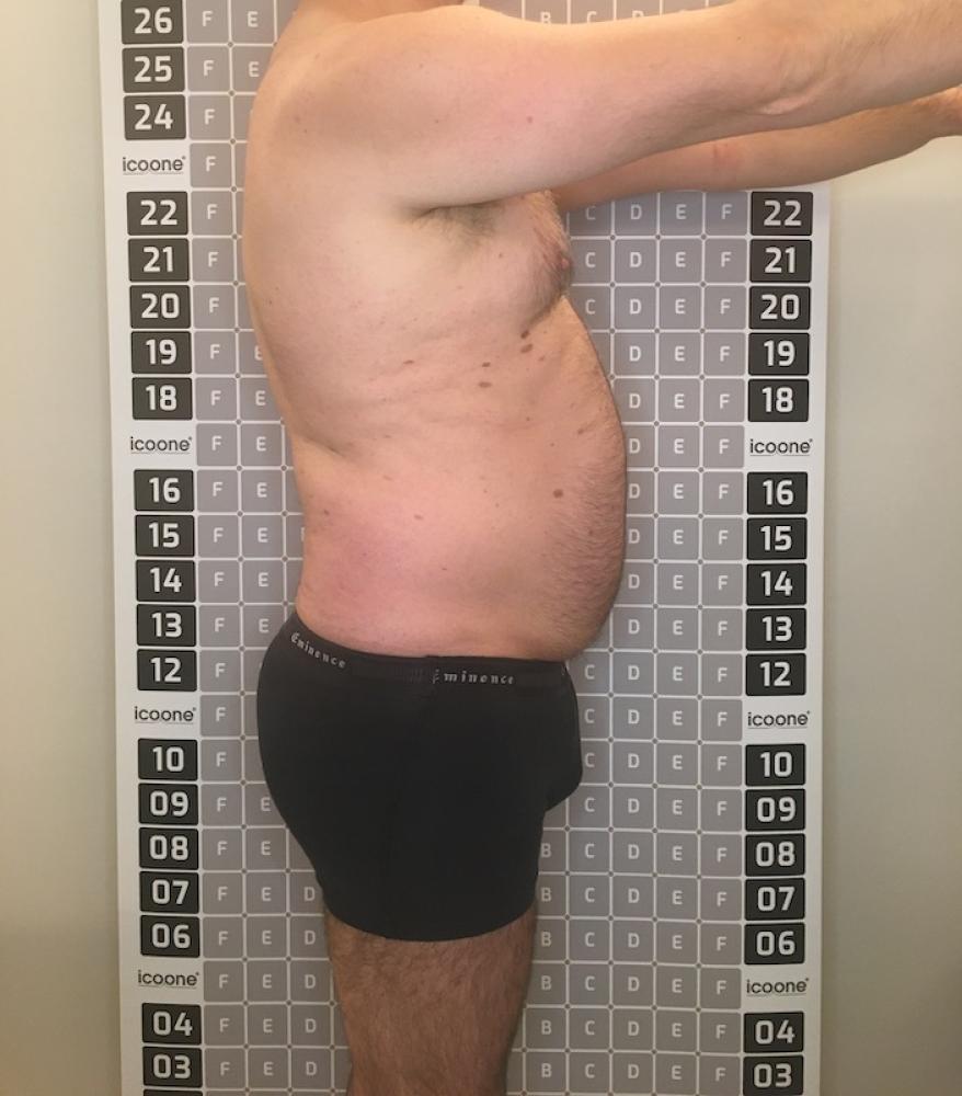 Avant cure amincissante Lille