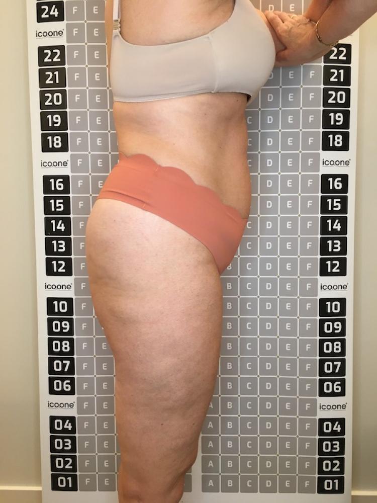 Après cure amincissante Lille