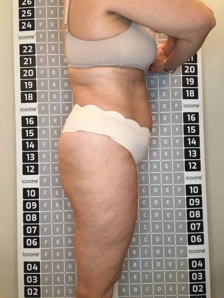 Avant cure amincissante Lille