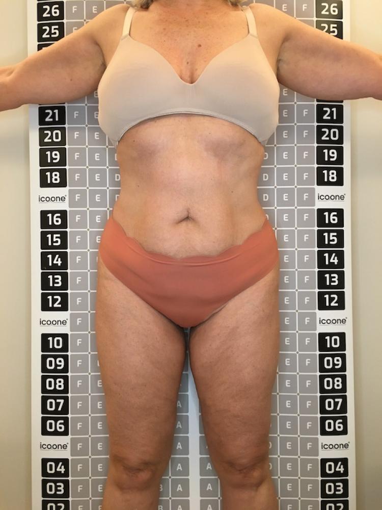 Après cure amincissante Lille