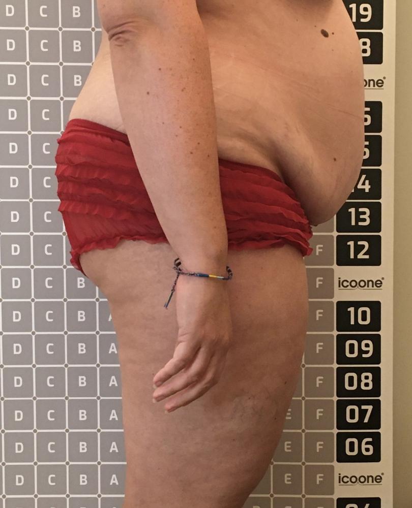 Avant cure amincissante Lille